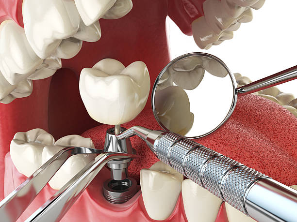 Best Emergency Treatment for Oral Infections in Royal Palm Beach, FL